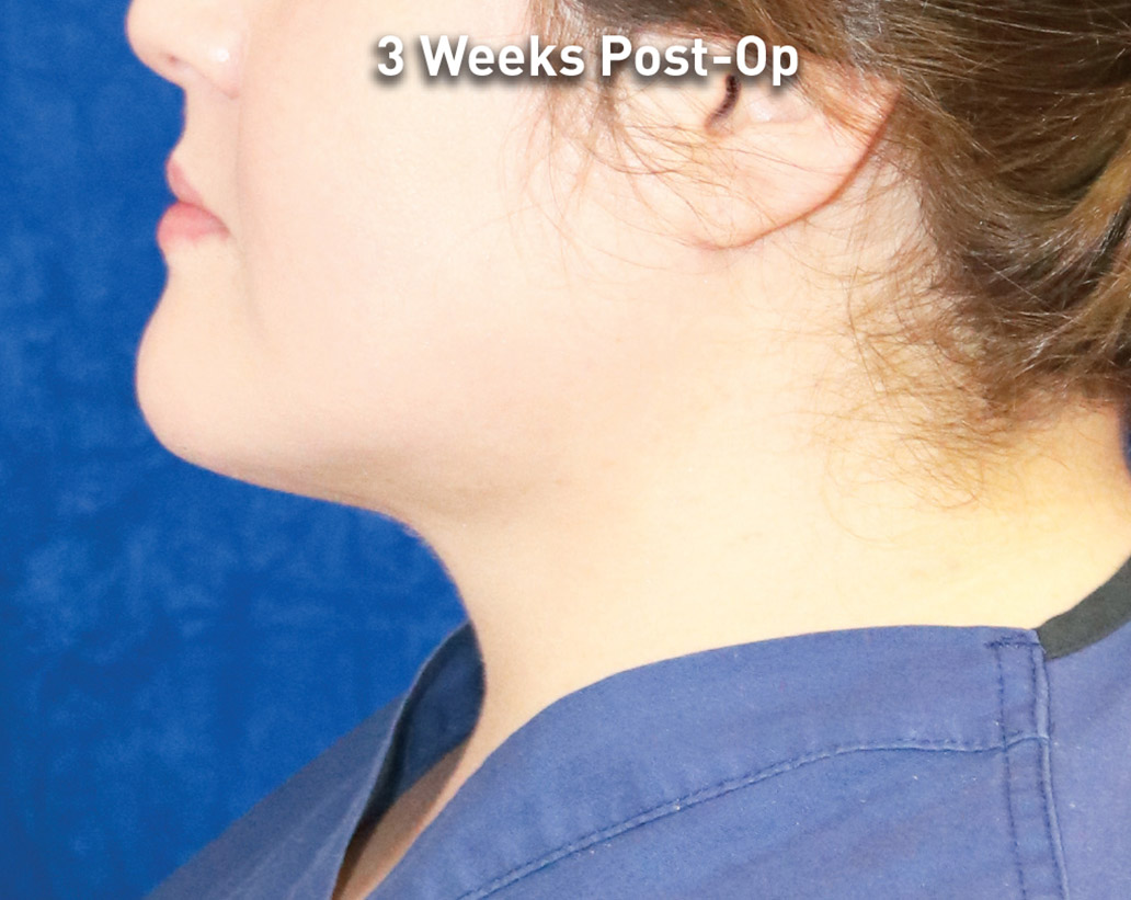 Renuvion Skin Tightening Before and After | Montilla Plastic Surgery