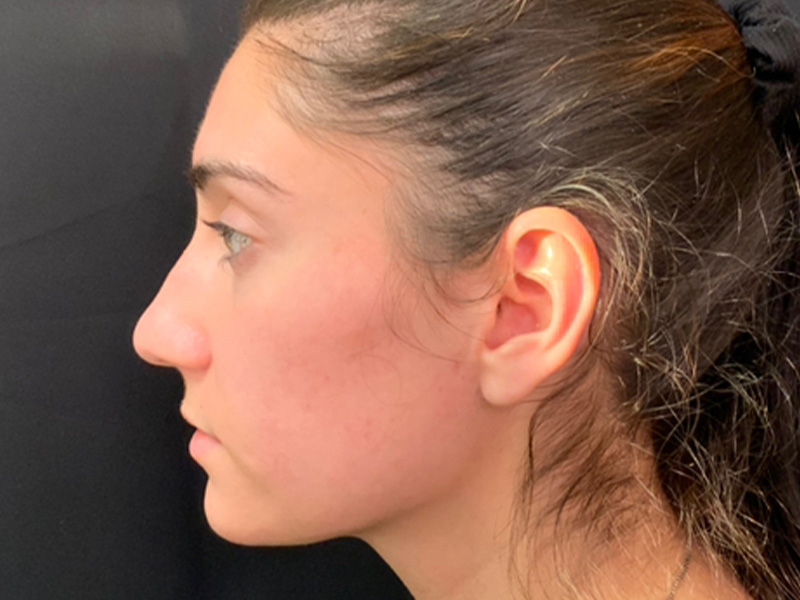 Rhinoplasty Before and After | Montilla Plastic Surgery