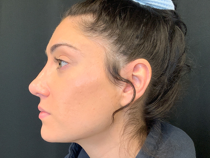 Rhinoplasty Before and After | Montilla Plastic Surgery