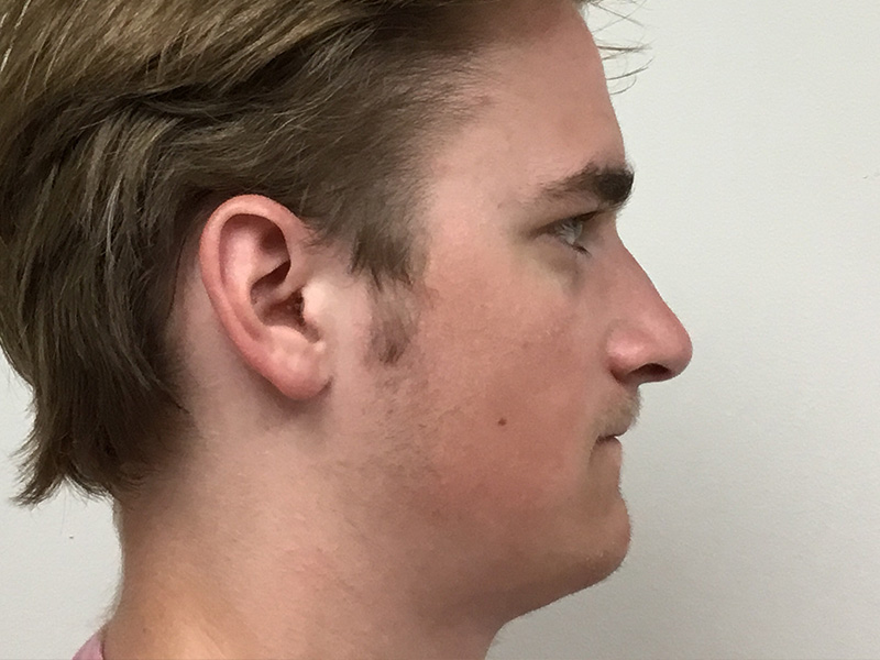 Rhinoplasty Greater Boston Area before 1