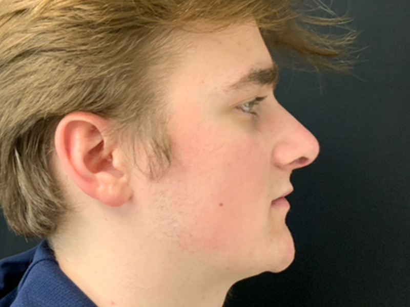 Rhinoplasty Greater Boston Area after 1