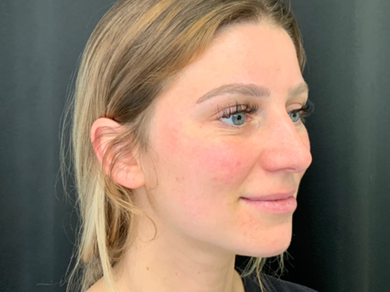 Rhinoplasty Greater Boston Area before 2