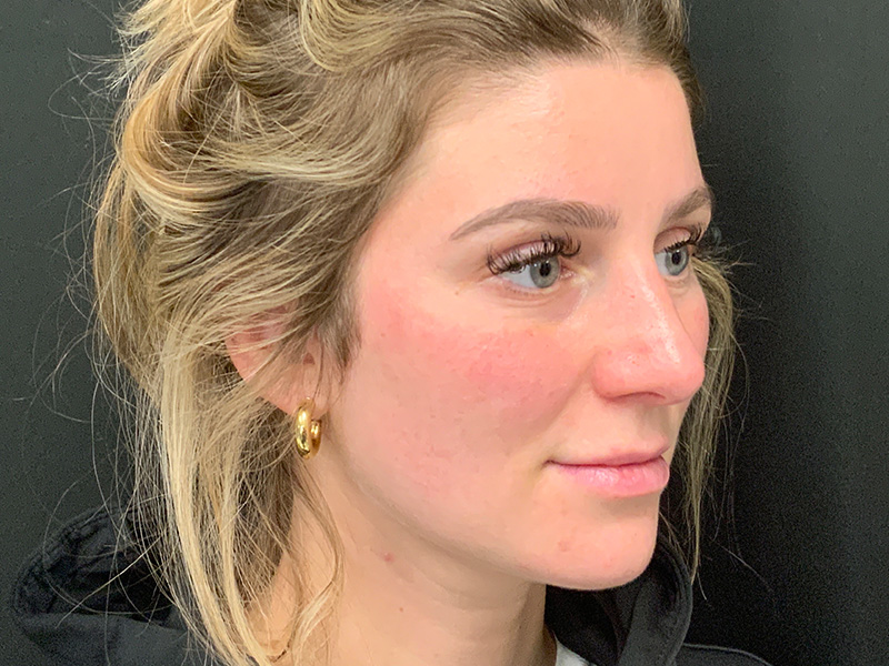 Rhinoplasty Greater Boston Area after 2