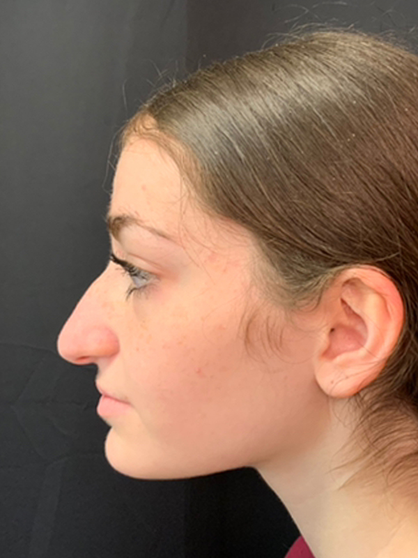 Rhinoplasty Before and After | Montilla Plastic Surgery