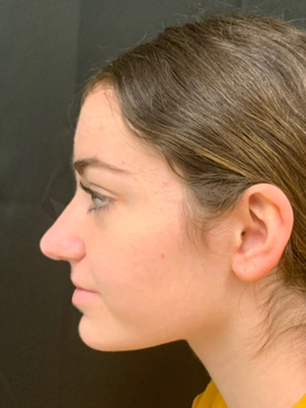 Rhinoplasty Before and After | Montilla Plastic Surgery