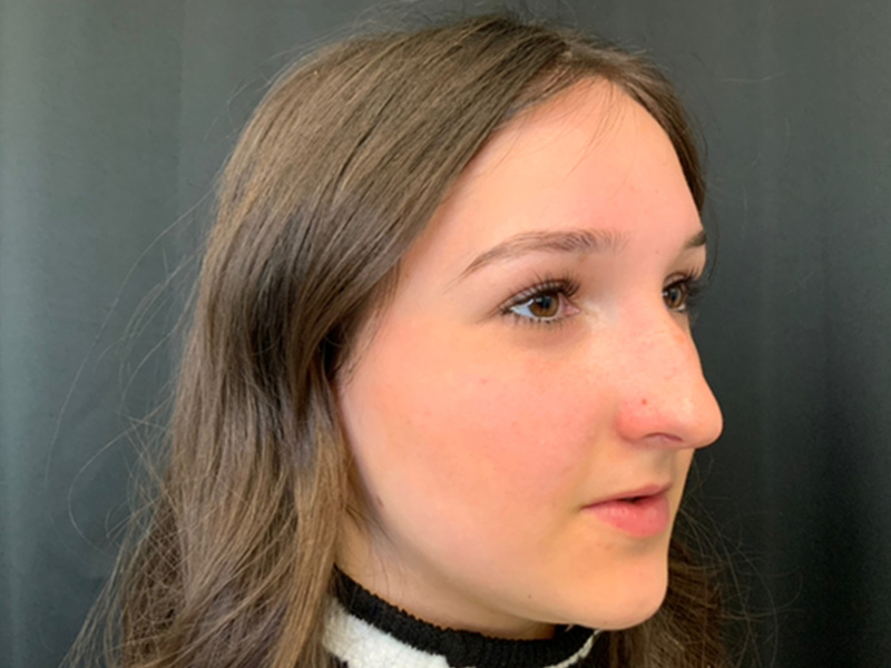 Rhinoplasty Before and After | Montilla Plastic Surgery