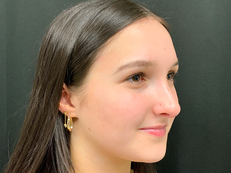 Rhinoplasty Before and After | Montilla Plastic Surgery