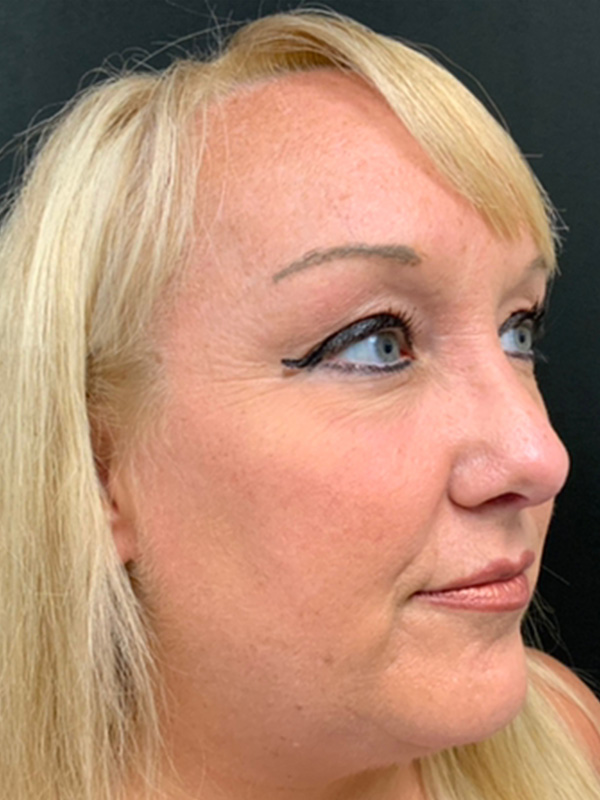 Rhinoplasty Before and After | Montilla Plastic Surgery