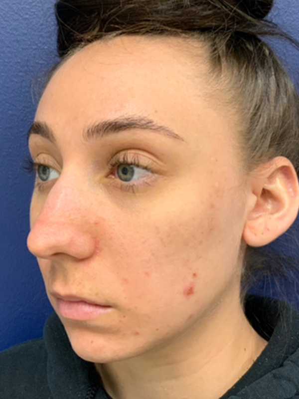 Rhinoplasty Before and After | Montilla Plastic Surgery