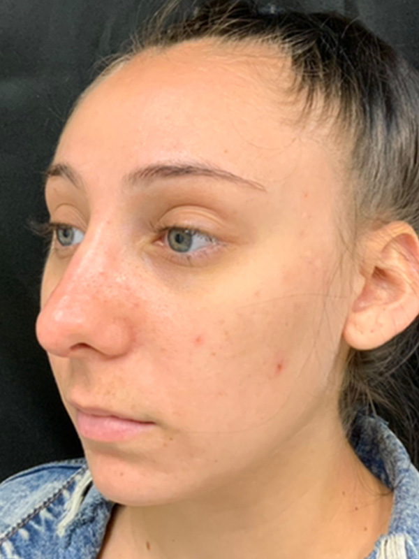 Rhinoplasty Before and After | Montilla Plastic Surgery