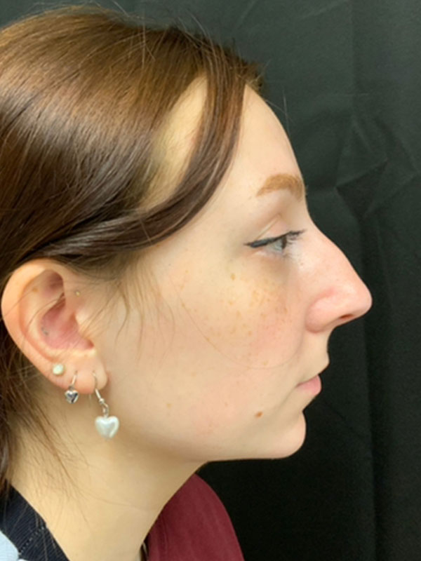 Rhinoplasty Before and After | Montilla Plastic Surgery