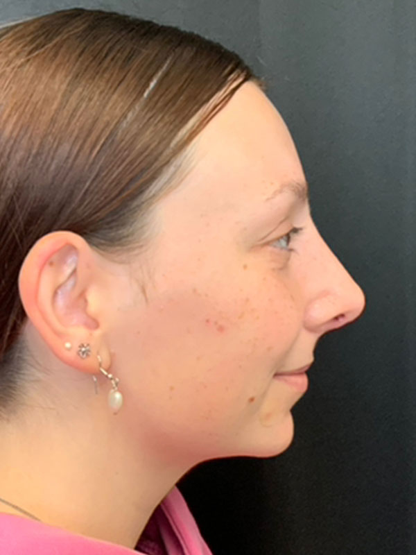 Rhinoplasty Before and After | Montilla Plastic Surgery