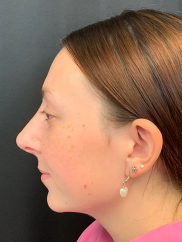 Rhinoplasty Before and After | Montilla Plastic Surgery
