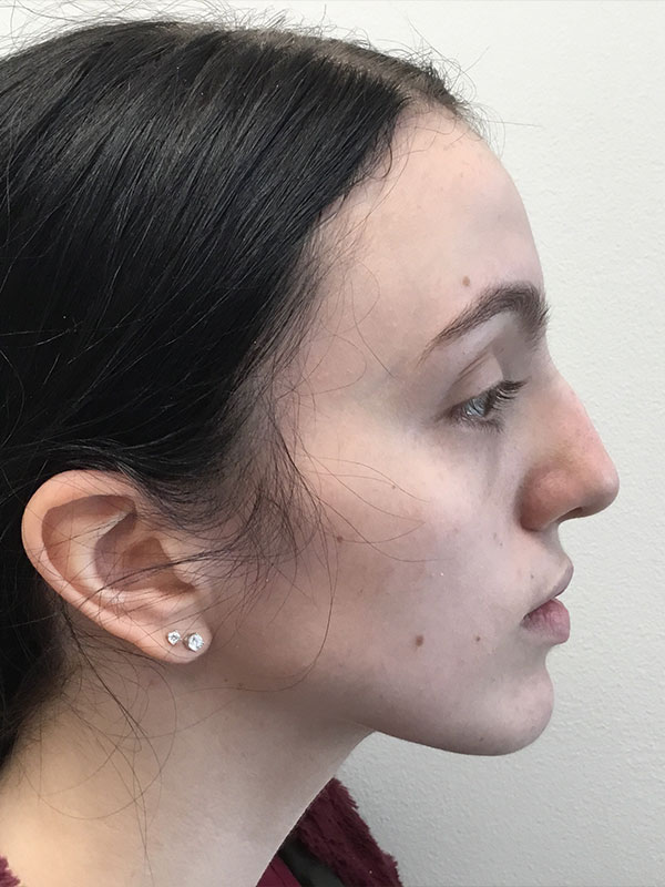 Rhinoplasty Before and After | Montilla Plastic Surgery