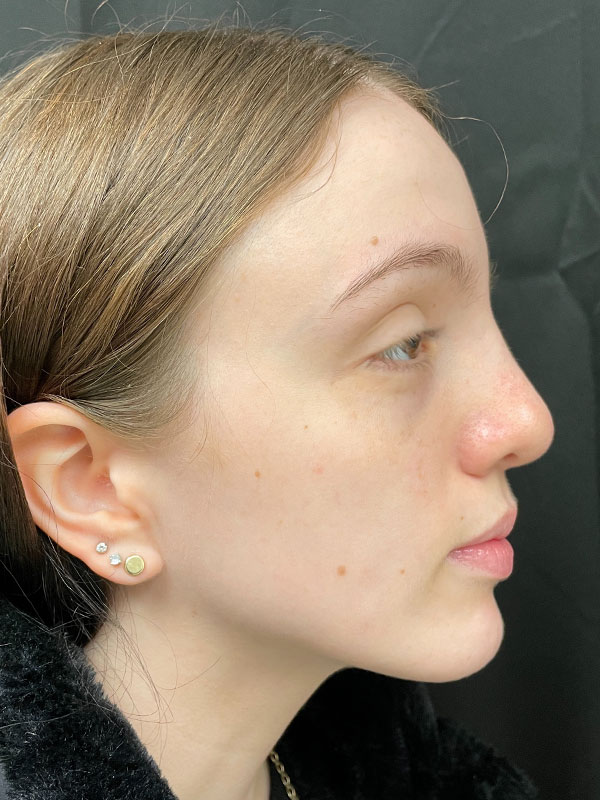 Rhinoplasty Before and After | Montilla Plastic Surgery