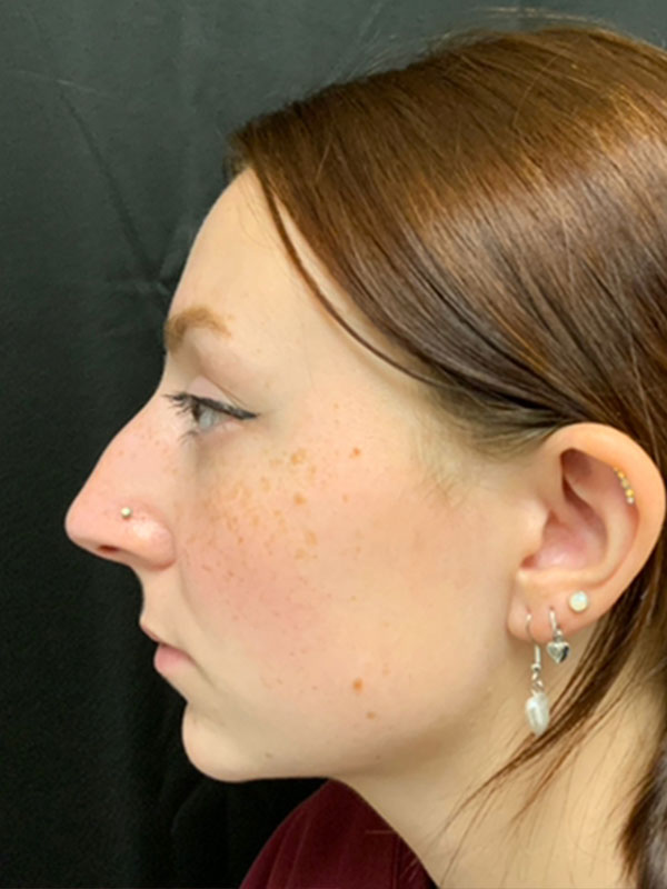 Rhinoplasty Before and After | Montilla Plastic Surgery