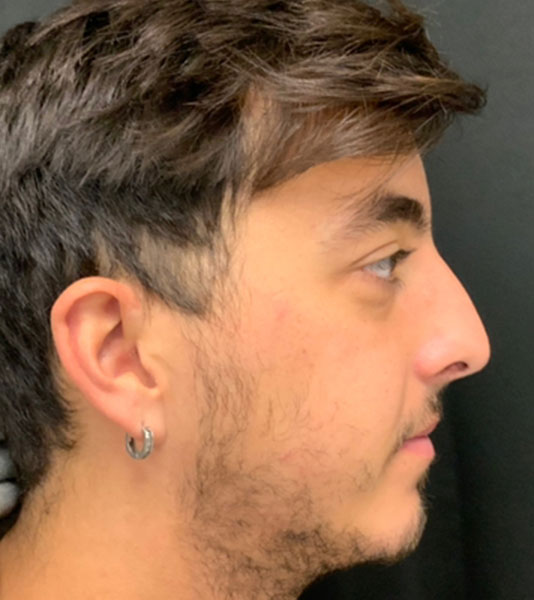 Rhinoplasty Before and After | Montilla Plastic Surgery