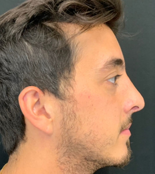 Rhinoplasty Before and After | Montilla Plastic Surgery