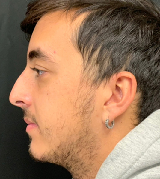 Rhinoplasty Before and After | Montilla Plastic Surgery