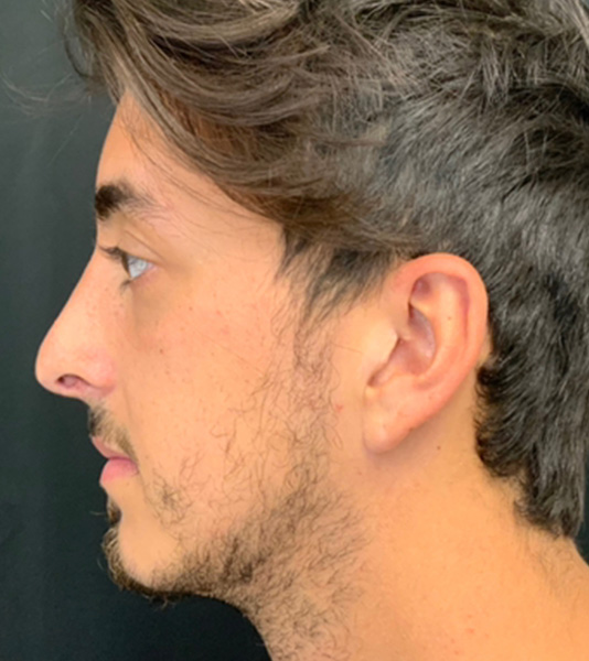 Rhinoplasty Before and After | Montilla Plastic Surgery