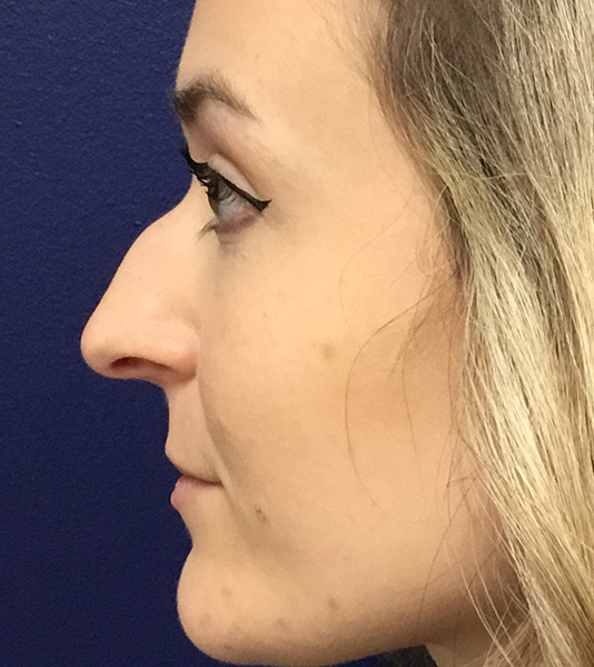 Rhinoplasty Before and After | Montilla Plastic Surgery