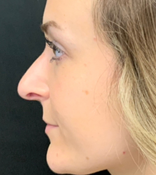 Rhinoplasty Before and After | Montilla Plastic Surgery