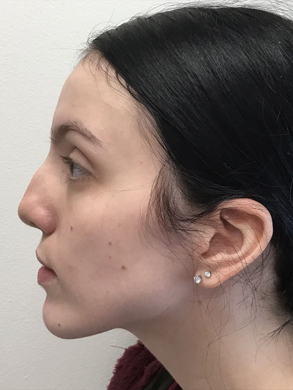 Rhinoplasty Before and After | Montilla Plastic Surgery