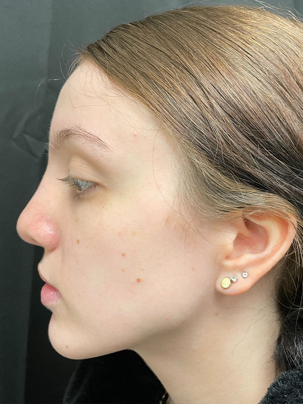 Rhinoplasty Before and After | Montilla Plastic Surgery
