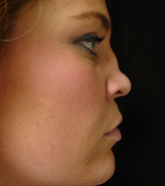 Rhinoplasty Before and After | Montilla Plastic Surgery