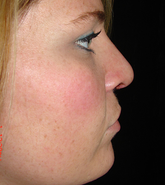 Rhinoplasty Before and After | Montilla Plastic Surgery