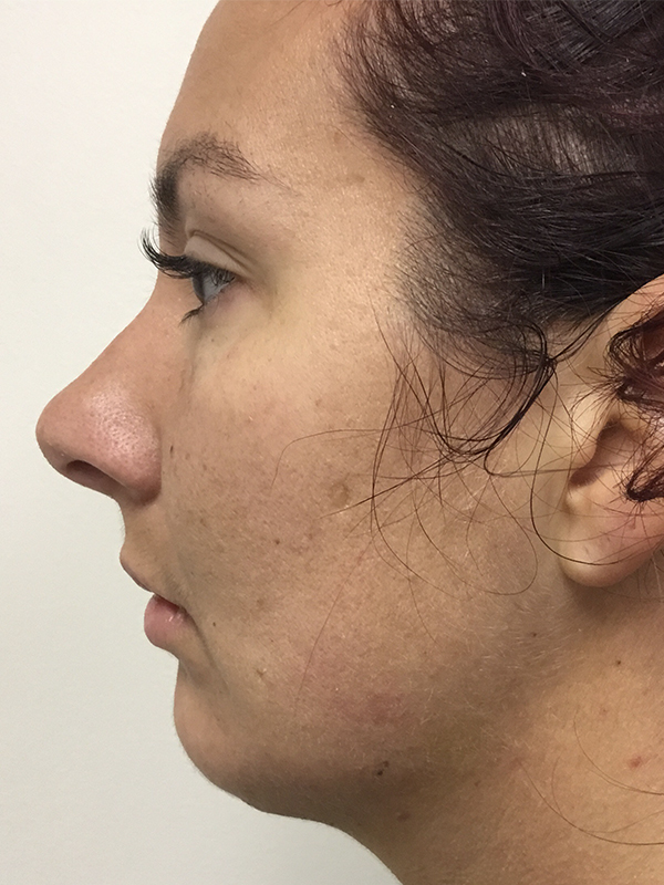 Rhinoplasty Before and After | Montilla Plastic Surgery