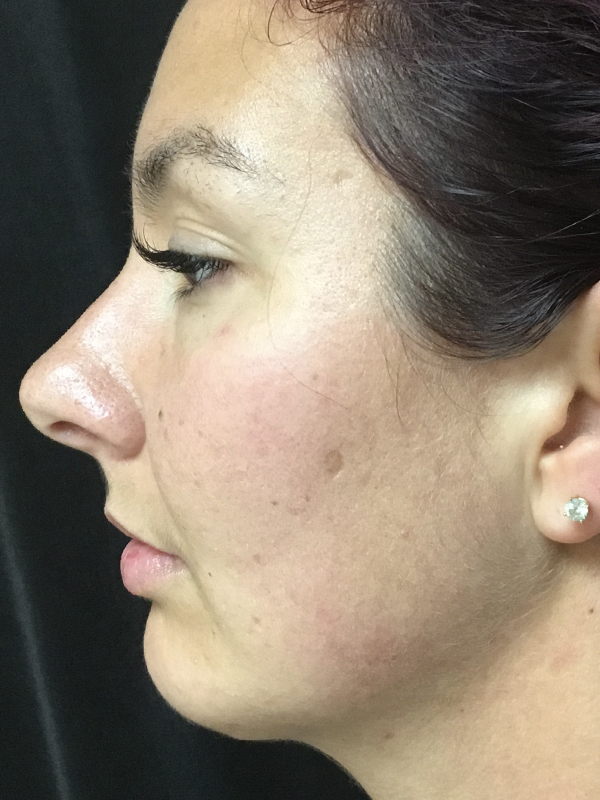 Rhinoplasty Before and After | Montilla Plastic Surgery