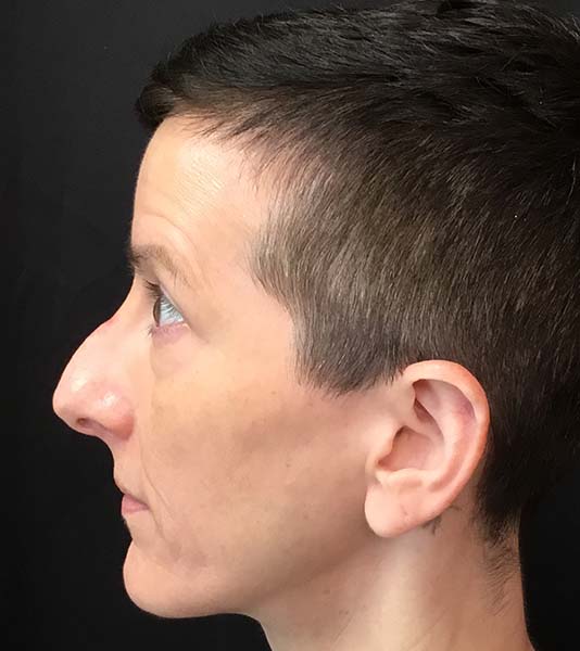 Rhinoplasty Before and After | Montilla Plastic Surgery