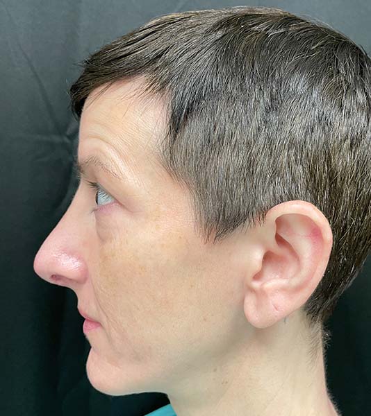 Rhinoplasty Before and After | Montilla Plastic Surgery