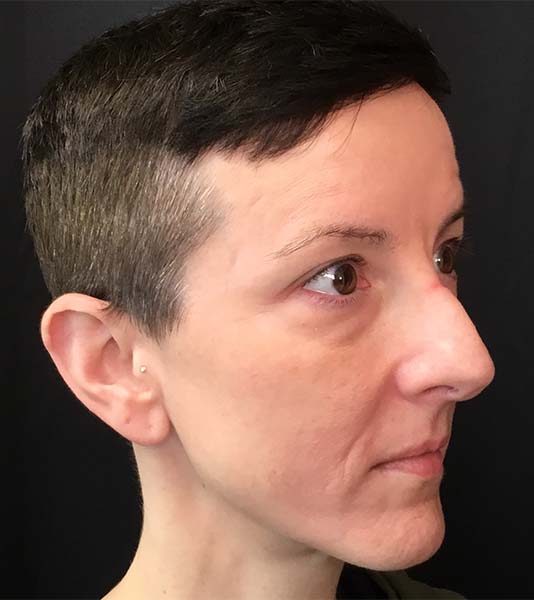 Rhinoplasty Before and After | Montilla Plastic Surgery