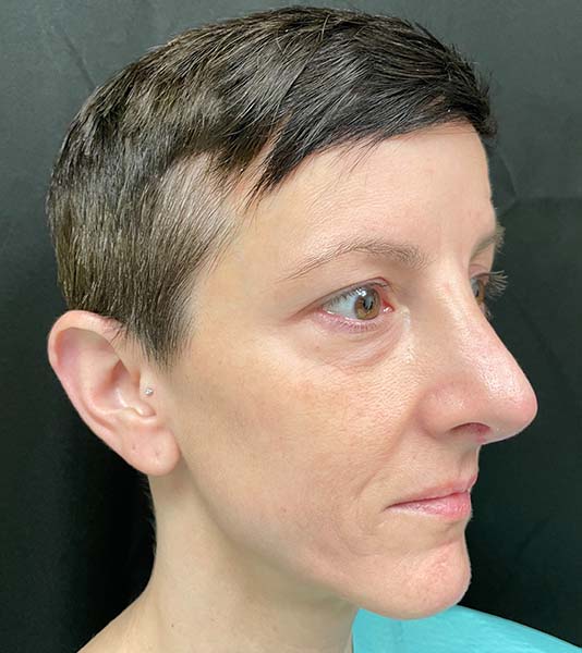 Rhinoplasty Before and After | Montilla Plastic Surgery