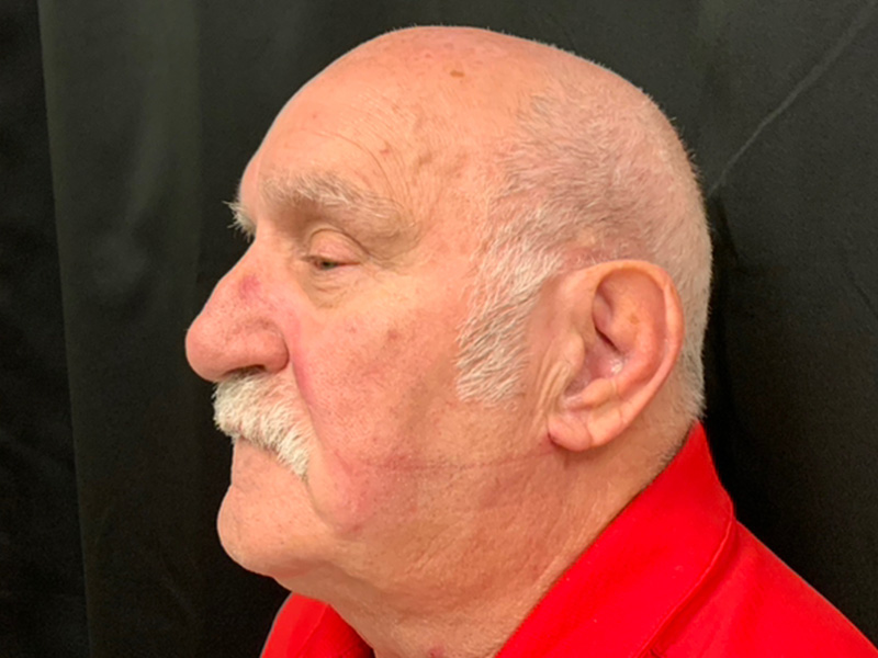 Rhinoplasty Before and After | Montilla Plastic Surgery