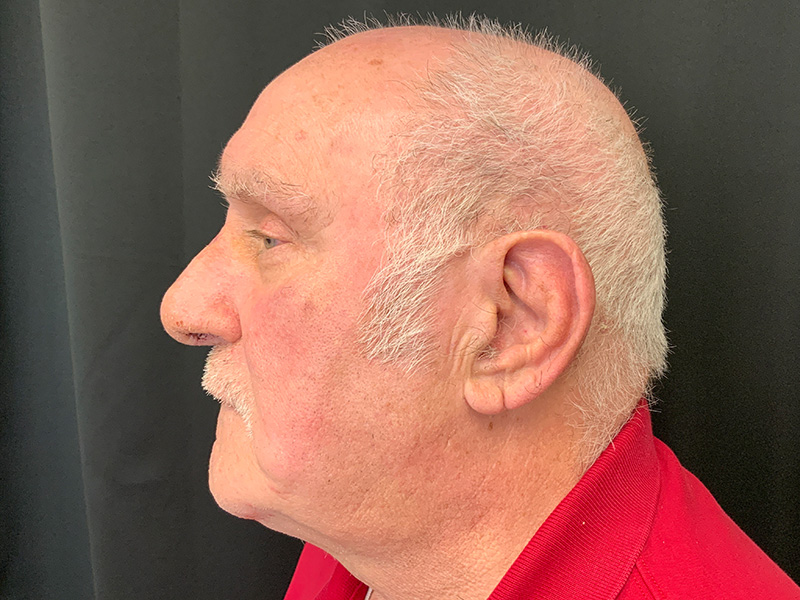 Rhinoplasty Before and After | Montilla Plastic Surgery