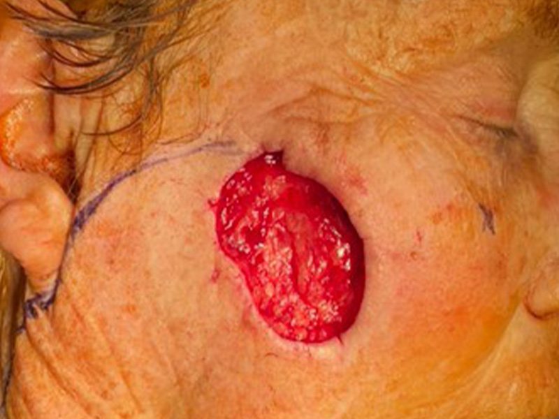Skin Cancer Reconstruction Before and After | Montilla Plastic Surgery 
