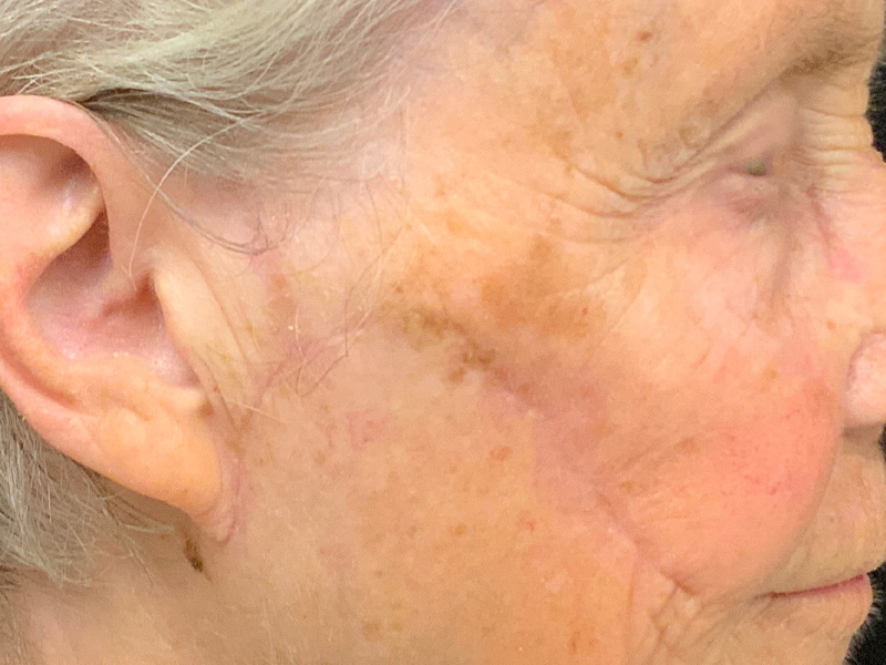 Skin Cancer Reconstruction Before and After | Montilla Plastic Surgery 