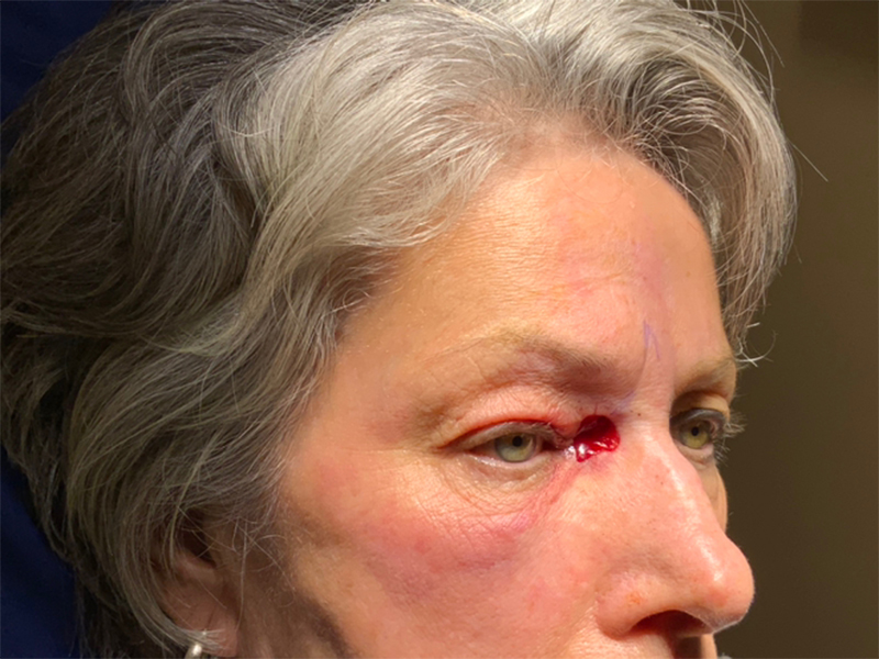 Skin Cancer Reconstruction Before and After | Montilla Plastic Surgery 