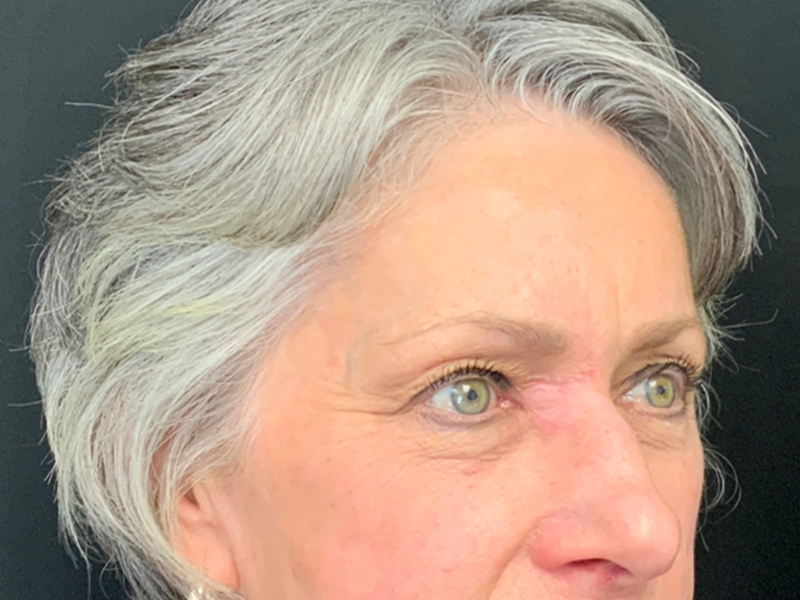 Skin Cancer Reconstruction Before and After | Montilla Plastic Surgery 