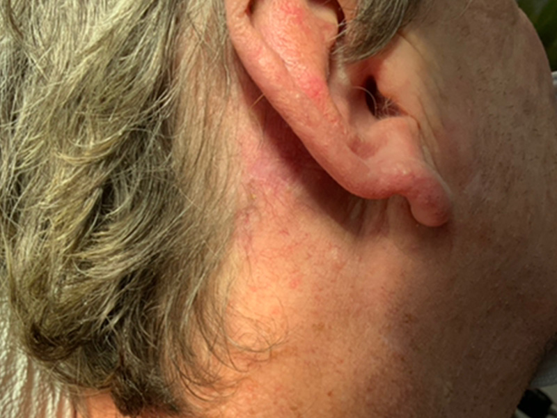 Skin Cancer Reconstruction Before and After | Montilla Plastic Surgery 
