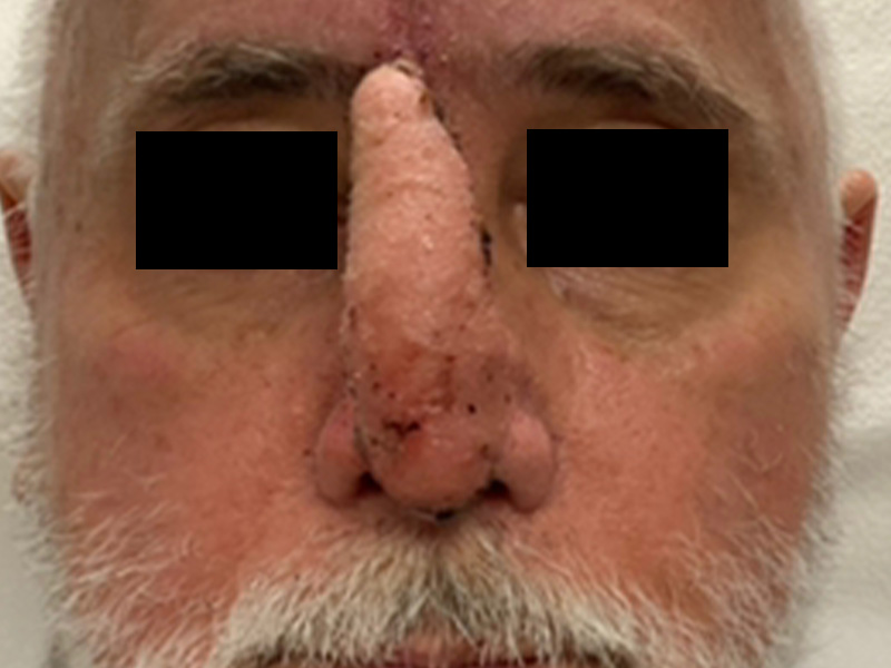 Skin Cancer Reconstruction Before and After | Montilla Plastic Surgery