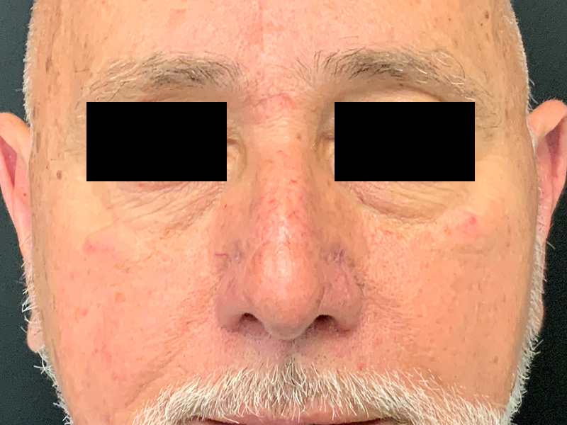 Skin Cancer Reconstruction Before and After | Montilla Plastic Surgery