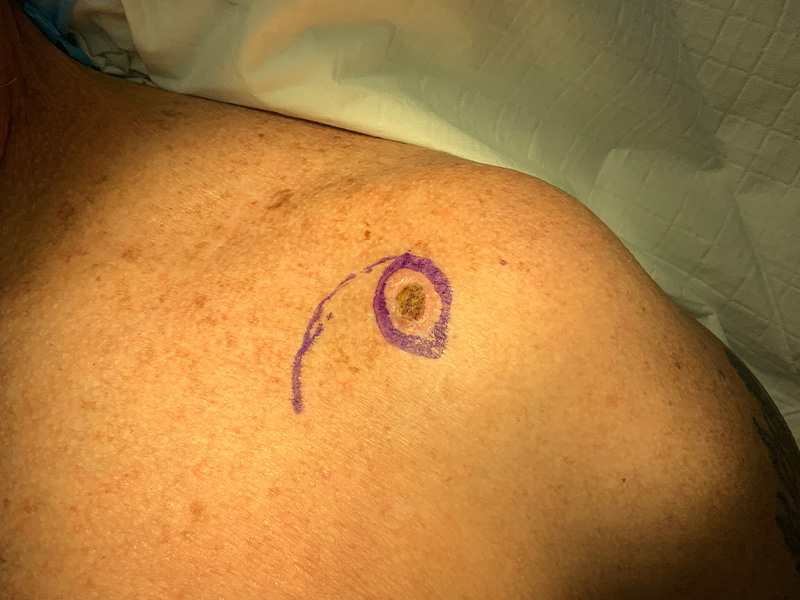 Skin Cancer Reconstruction Before and After | Montilla Plastic Surgery 
