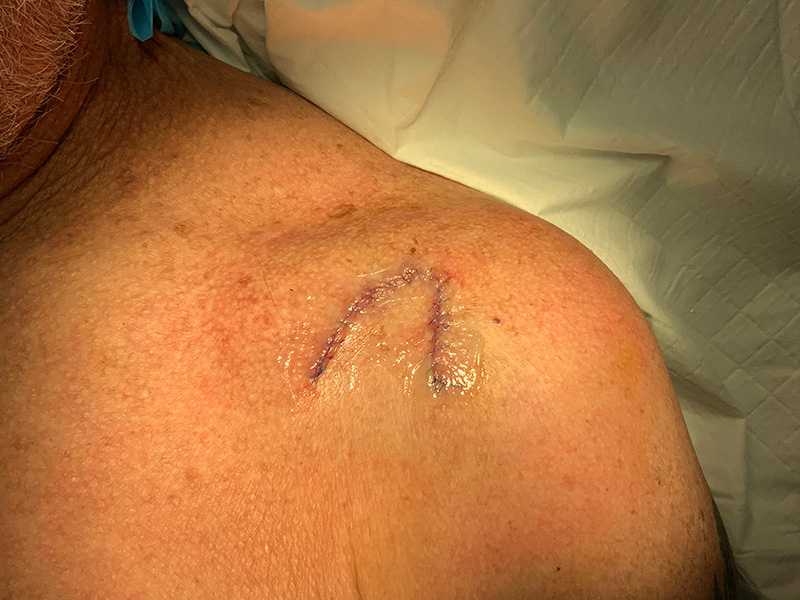 Skin Cancer Reconstruction Before and After | Montilla Plastic Surgery 