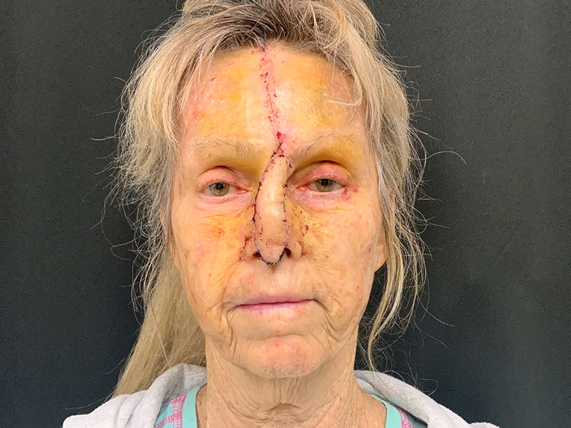 Skin Cancer Reconstruction Before and After | Montilla Plastic Surgery 