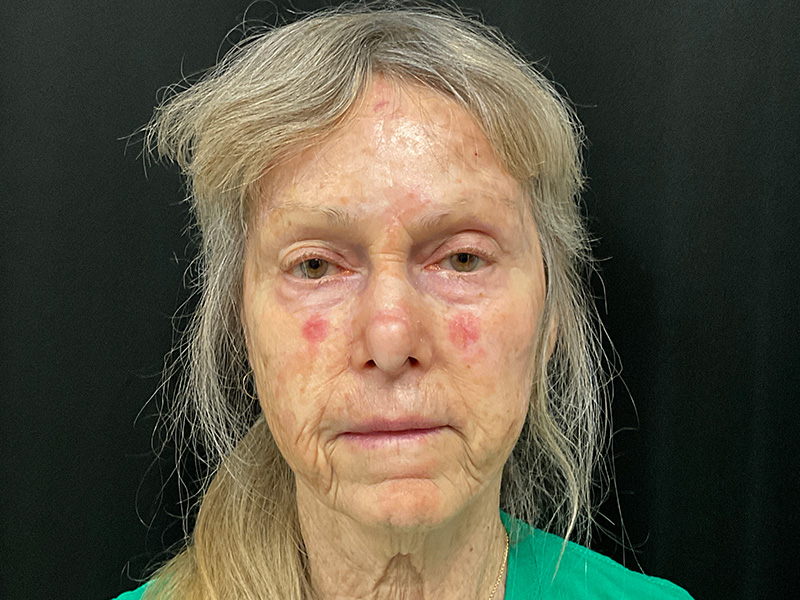 Skin Cancer Reconstruction Before and After | Montilla Plastic Surgery 