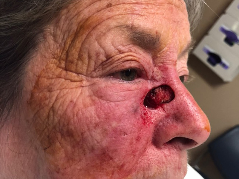 Skin Cancer Reconstruction Before and After | Montilla Plastic Surgery 